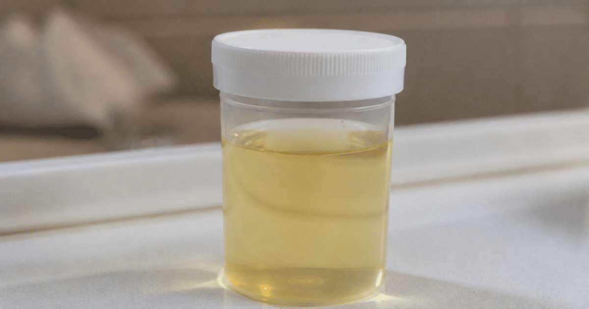 Flacon medical transparent contenant echantillon urine jaune pale